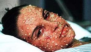 stalin smallpox